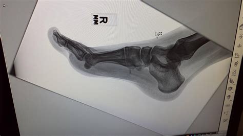 Turns out glass shows up on an xray. My foot after a work injury ...