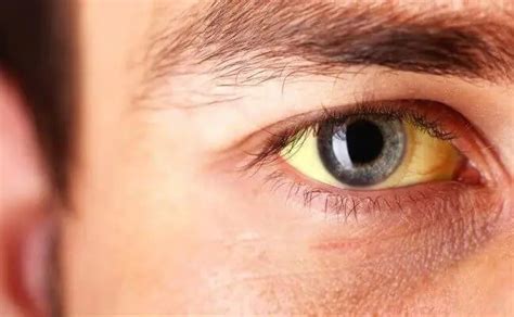 Signs and Symptoms of Jaundice - Medical Blog For Students