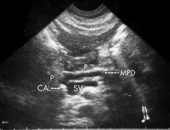 Pancreatic Duct Dilation Ultrasound