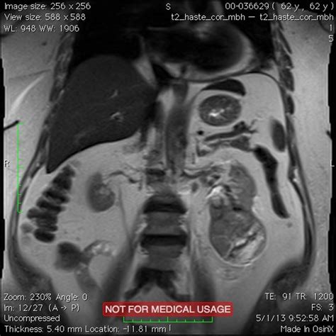 Renal cell carcinoma MRI - wikidoc