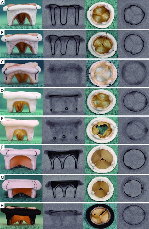 Surgical bioprosthetic mitral valves and their fluoroscopic appearance ...