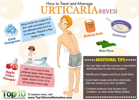 How to Treat and Manage Urticaria - Page 2 of 3 | Top 10 Home Remedies