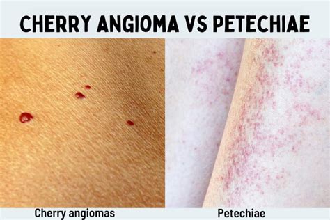 Cherry Angioma vs. Petechiae: What's the Difference?