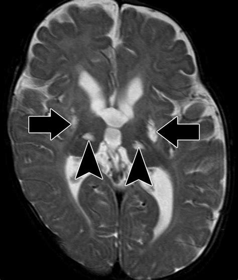 Hypoxic Ischemic Brain Injury Imaging Findings From Birth To Adulthood ...