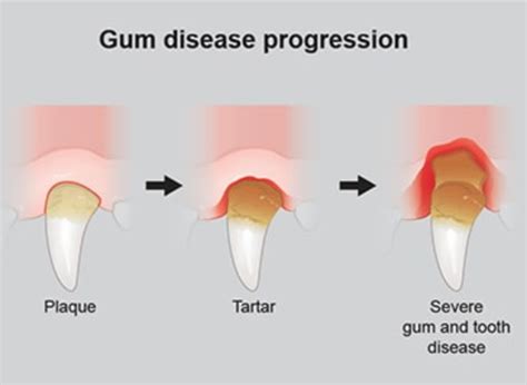 Periodontitis in Dogs: Learn Dog Tooth Decay Stages