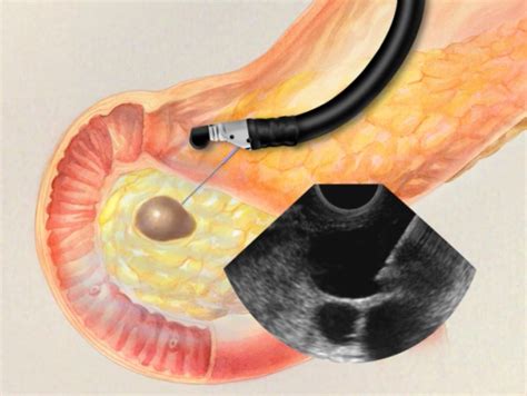 Endoscopic Ultrasound with Fine Needle Aspiration Biopsy, Animation ...