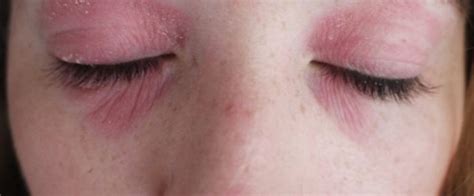 Why Is the Skin Around My Eyes Dry, Itchy and Red? - Skincarederm