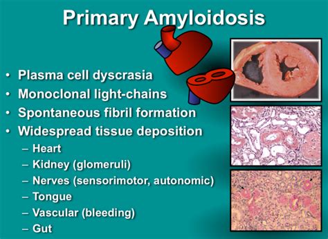 Amyloidosis : Causes ,Types, Symptoms, Treatments & Prognosis » How To ...