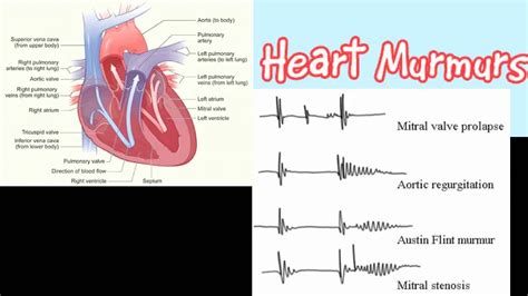 Heart Murmur - YouTube