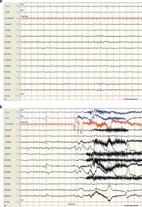 Abnormal eeg - creationamela