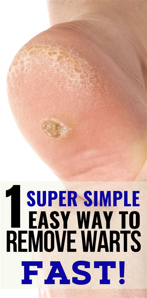 The Easiest Way to Get Rid of Warts Naturally | Home remedies for warts ...