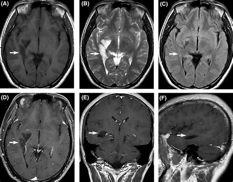 Intraventricular dysembryoplastic neuroepithelial tumor in the temporal ...