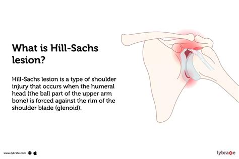 Hill-Sachs lesion: Causes, Symptoms, Treatment and Cost