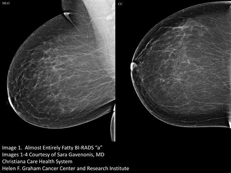 Your patient got a dense breast notification with her mammogram report ...