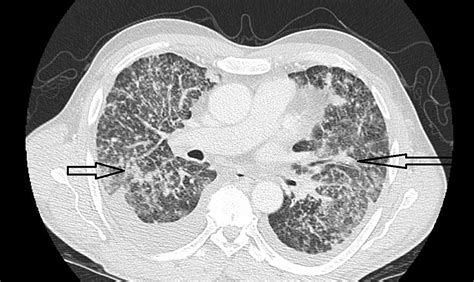 Cureus | A Case of Rapidly Deteriorating Lymphangitic Carcinomatosis in ...