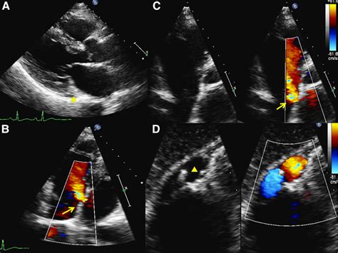 Mimic of Atrial Septal Defect | Circulation: Cardiovascular Imaging