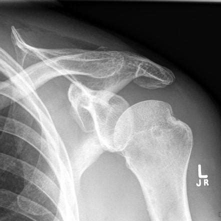 Hill Sachs Lesion | Best Shoulder Surgery & Arthroscopy | Bangalore