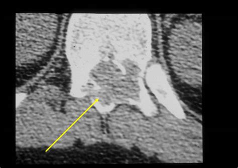 Osteoblastoma Spine