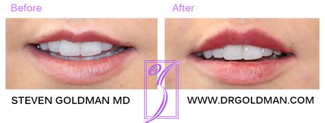 Lip Flip vs Lip filler - Beachwood Plastic Surgery and Medical Spa