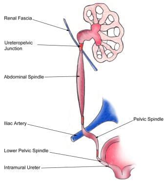 Ureteroneocystostomy：概述，准备技术