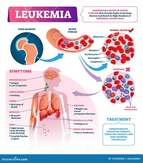 Symptoms Of Leukemia Vector Illustration | CartoonDealer.com #70924356