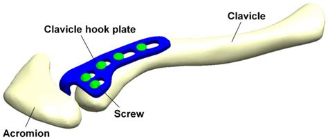 Frontiers | Biomechanical effects of different numbers and locations of ...