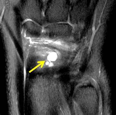 Ganglion Cyst Hand Mri