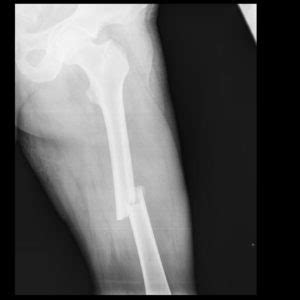 Orthopaedic Surgery for Fractures & Trauma