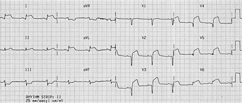 Lateral STEMI ECG changes • LITFL • ECG Library Diagnosis