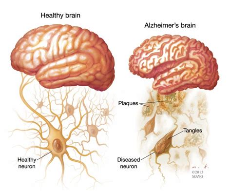 Alzheimers Disease Causes, Symptoms, Treatments and Nursing Care for ...