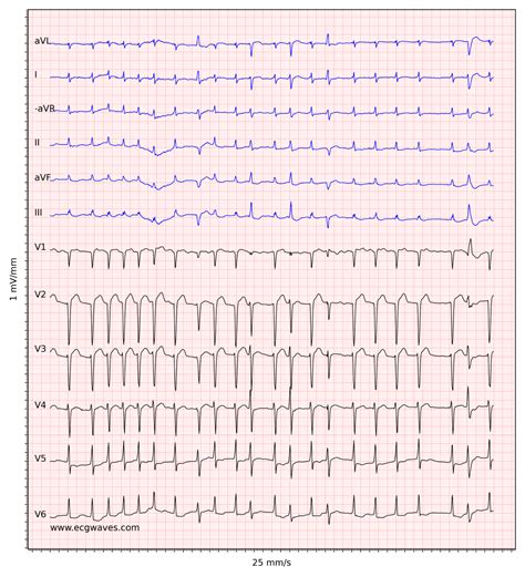 Atrial fibrillation: ECG, classification, causes, risk factors ...