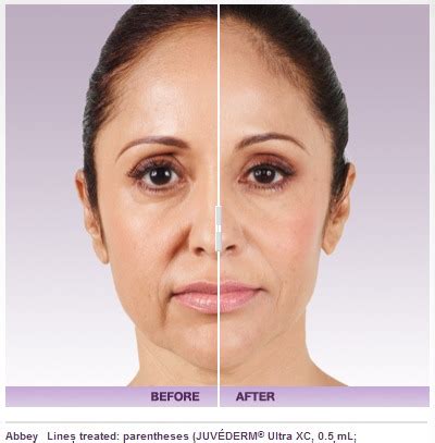 Juvederm Filler – Cost, Results, Risks, Side Effects | Beverly Hills