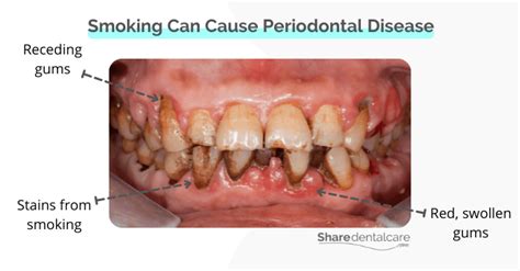 Can Smoking Cause Periodontal Disease? - Share Dental Care