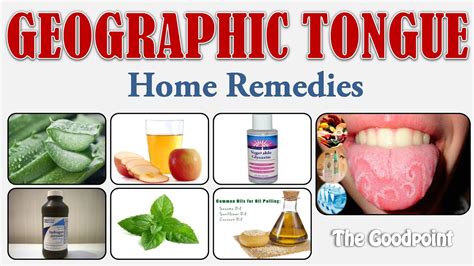 Home Remedies for Geographic Tongue | TheGoodPoint - The Good Point