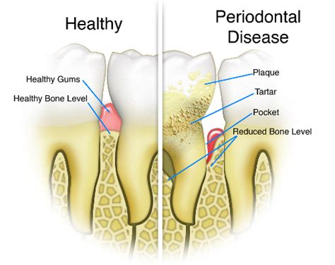 Postmenopausal Women with Gum Disease Face Greater Cancer Risk