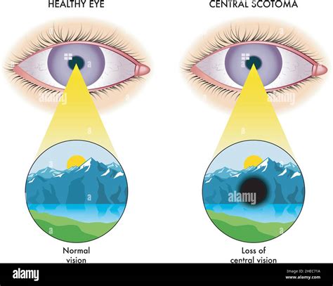 Central scotoma hi-res stock photography and images - Alamy