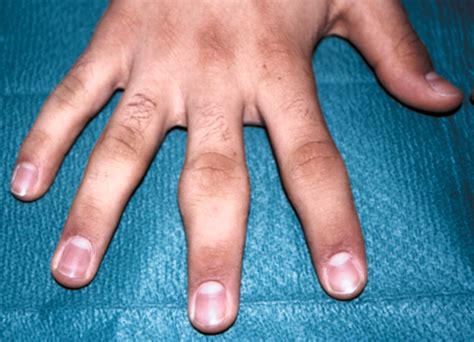 Finger joint swellings in a teenager: juvenile rheumatoid arthritis or ...