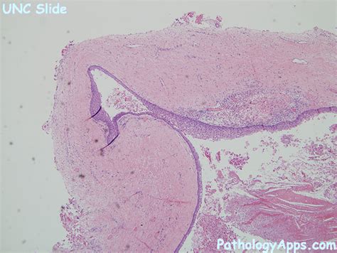 dentigerous cyst pathology