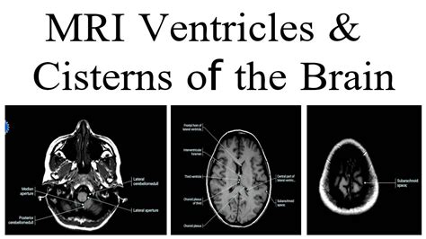 MRI ventricle and cisterns of the Brain - YouTube