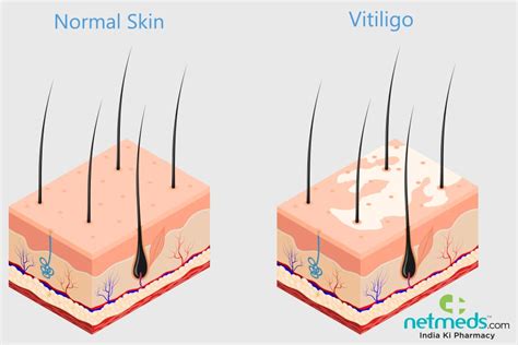 Vitiligo: Causes, Symptoms and Treatment