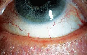 MGD is one of the main causes for dry eye syndrome. - Health ...