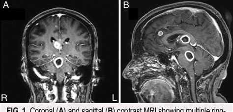 Figure 1 from Hypertrophic olivary degeneration and palatal myoclonus ...