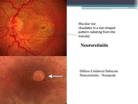 Optic neuritis