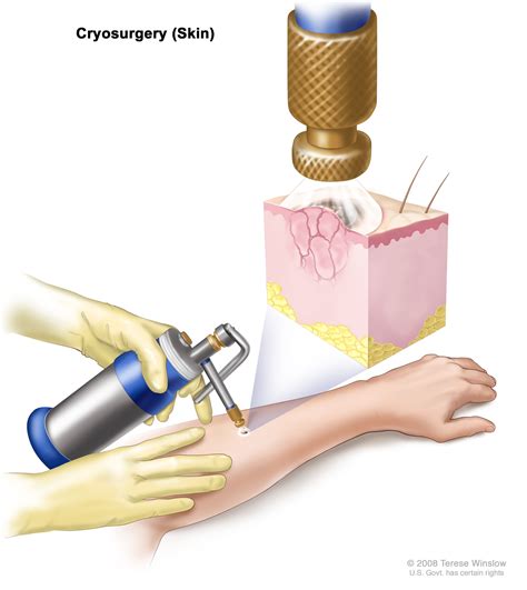 Skin Cancer Treatment - NCI