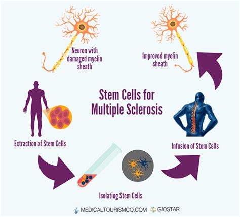 Multiple sclerosis and stem cell therapy – QQMCUO