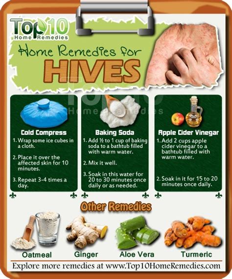 Home Remedies for Hives | Top 10 Home Remedies