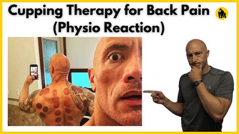 Cupping therapy for back pain - YouTube