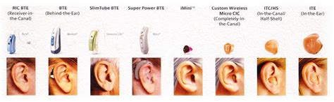 Types of Hearing Loss | Sensorineural | Conductive | Mixed | Neural