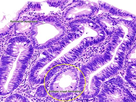 Familial adenomatous polyposis pathophysiology - wikidoc