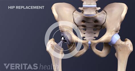 All About Anterior Hip Replacement